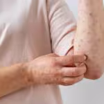 skin-allergy-on-person-s-arm